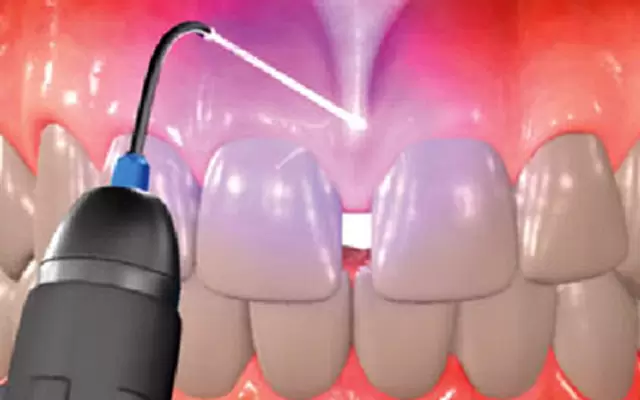 Laser Use In Dentistry1